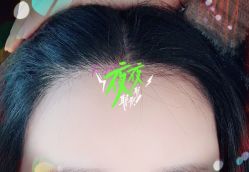 -大麦微针植发全国连锁
