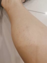 体验后-深圳春天阳光医院·轮廓抗衰中心