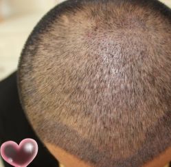 -大麦微针植发丨全国连锁