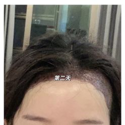 -大麦微针植发丨全国连锁