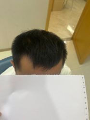 体验后-大麦微针植发丨全国连锁