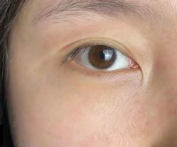 -天津健丽·去眼袋医疗美容机构