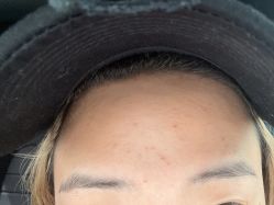 -悟空祛痘·诺奖技术专业店