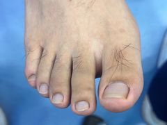 -Andrew指甲专科灰指甲·甲沟炎矫正·3D步态矫形鞋垫定制(浦三路店)
