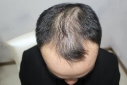 -大麦微针植发丨全国连锁