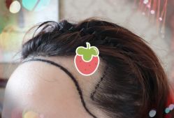 -大麦微针植发全国连锁