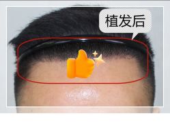 -大麦微针植发全国连锁