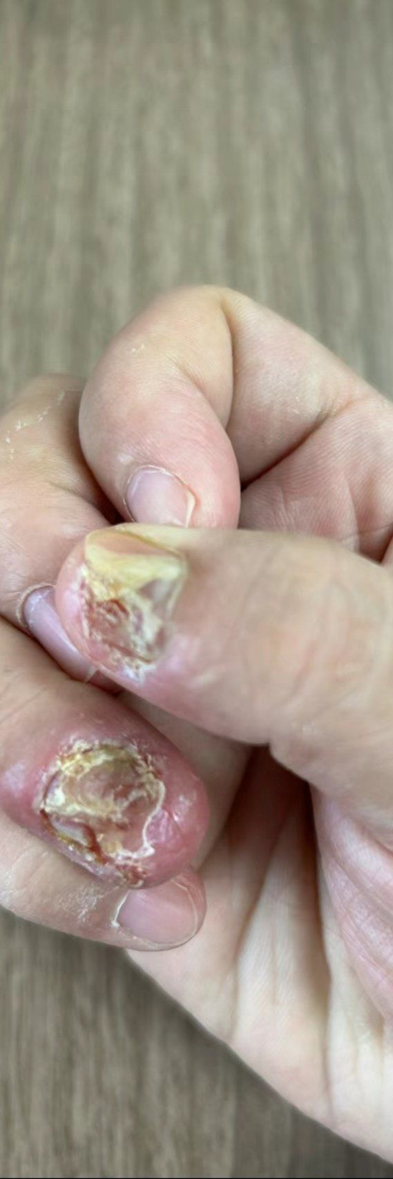 灰指甲一定要引起重视,平常也没啥影响