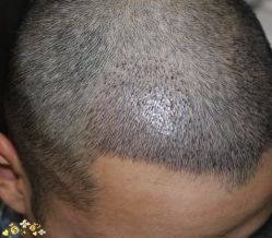 -大麦微针植发丨全国连锁