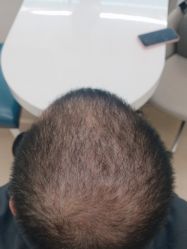 点击看大图 -大麦微针植发丨全国连锁