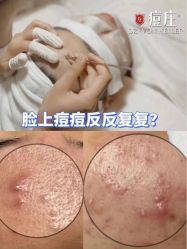 -痘庄科学祛痘国际连锁