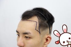 -大麦微针植发丨全国连锁