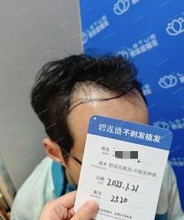 -碧莲盛·不剃发植发