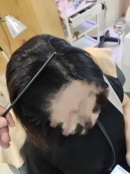 -大麦微针植发丨全国连锁