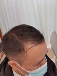 点击看大图 -碧莲盛·不剃发植发