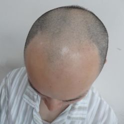 -碧莲盛·不剃发植发