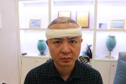 -大麦微针植发丨全国连锁