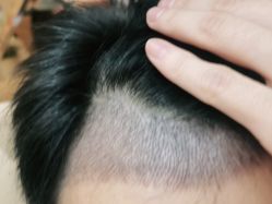 点击看大图 -碧莲盛·不剃发植发