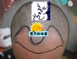 -大麦微针植发全国连锁