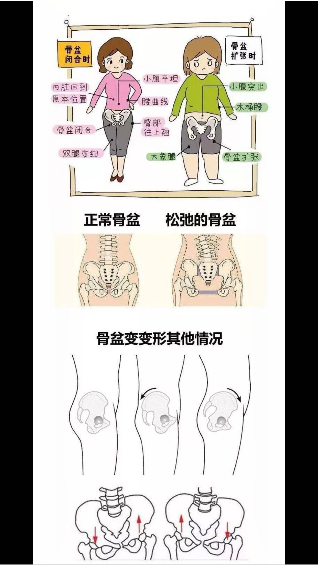 盆骨宽怎么变窄图片