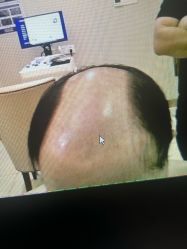 -大麦微针植发全国连锁