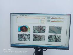 -大麦微针植发全国连锁