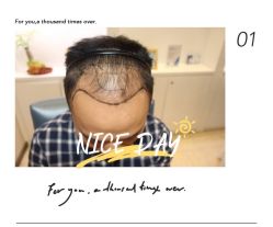 -大麦微针植发全国连锁