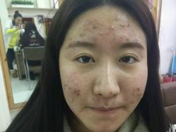 -苗方清颜专业祛痘