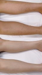 -薇兰专业脱毛连锁机构