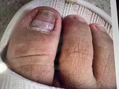 -世龙世家灰指甲鸡眼脚气甲沟炎跖疣护理(通州店)