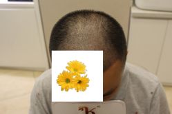 -大麦微针植发丨全国连锁