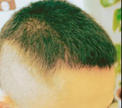-大麦微针植发丨全国连锁