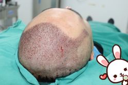 -大麦微针植发丨全国连锁