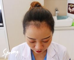 体验后-大麦微针植发全国连锁