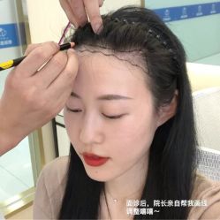 -碧莲盛·不剃发植发