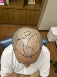 -大麦微针植发全国连锁