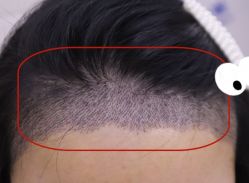 -大麦微针植发全国连锁