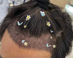 -大麦微针植发全国连锁