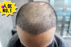 -大麦微针植发丨全国连锁