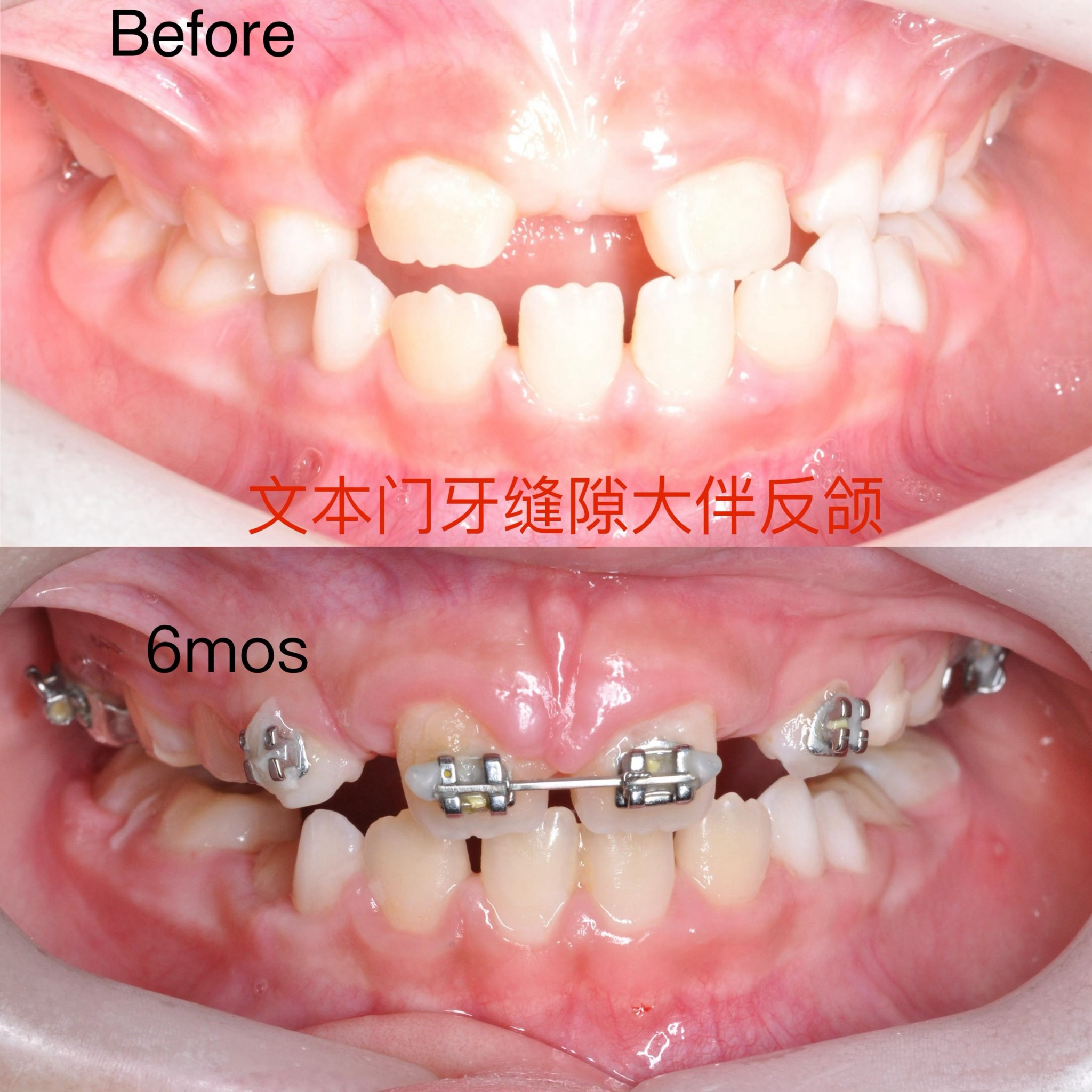 牙性反颌图片