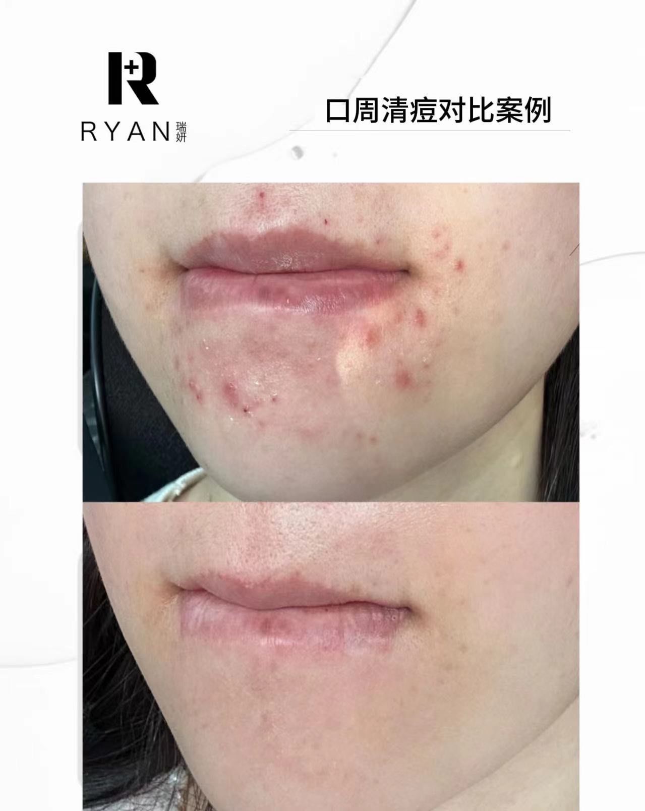 嘴巴周围为什么长痘痘 嘴巴周围为什么长痘痘