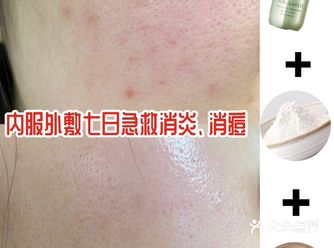 还没过年就已经大鱼大肉发满脸痘怎么办️