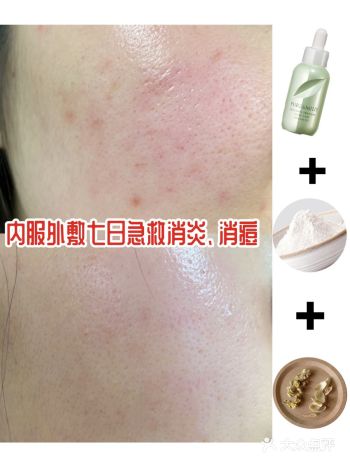 还没过年就已经大鱼大肉发满脸痘怎么办️