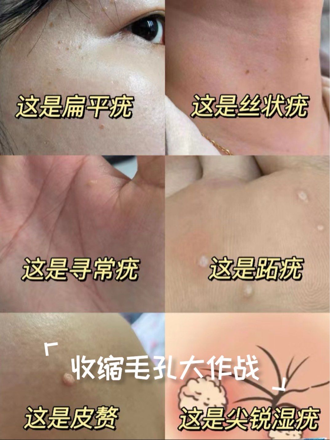 脸上长扁平疣必看!