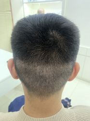 -大麦微针植发丨全国连锁