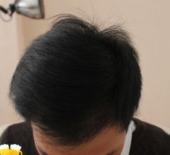 -大麦微针植发丨全国连锁