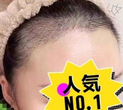 -大麦微针植发丨全国连锁