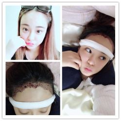 -大麦微针植发丨全国连锁