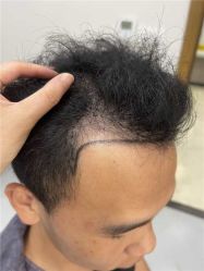 -大麦微针植发全国连锁