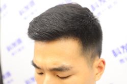 -大麦微针植发丨全国连锁